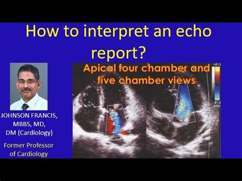normal echocardiography report|How to read an echocardiogram report .